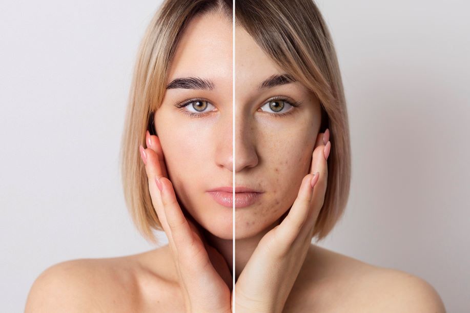 5 Effective Ways to Treat Acne Scars and Embrace Clearer Skin