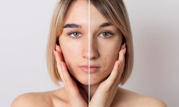 5 Effective Ways to Treat Acne Scars and Embrace Clearer Skin