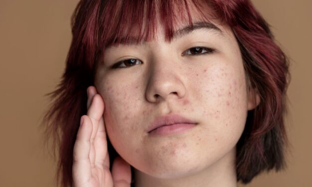 5 Effective Ways to Manage Hormonal Acne and Boost Your Confidence