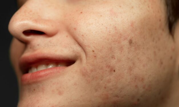 5 Effective Treatments for Skin Hyperpigmentation